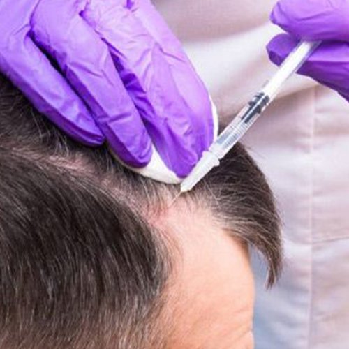 Affordable yet top-notch PRF hair restoration at Ziva Wellness on Chaparral Road, Scottsdale, Arizona
