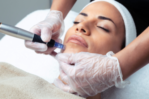 Read more about the article Microneedling FAQs: Unveiling the Secrets to Glowing Skin
