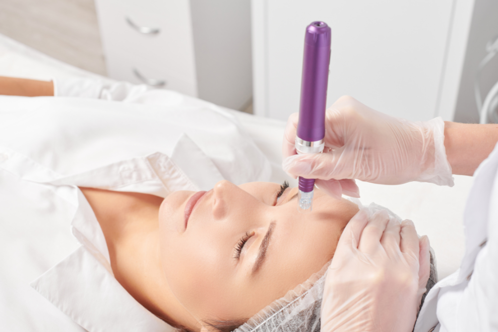 A person applying a gentle, soothing moisturizer to their face after microneedling.