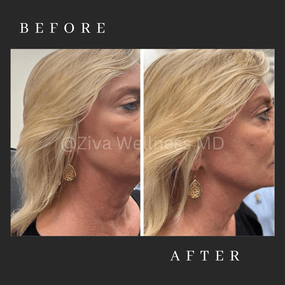 Fillers Scottsdale Arizona