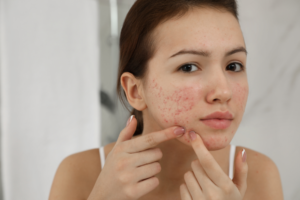 Read more about the article Salicylic Acid: Your Acne-Fighting Ally