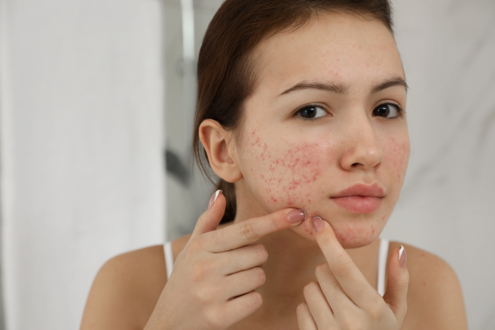 You are currently viewing Salicylic Acid: Your Acne-Fighting Ally