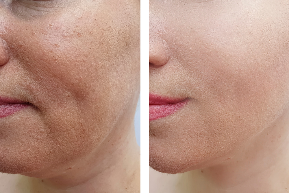 A split-screen image. On one side, a face showcases visible wrinkles and volume loss. The other side showcases the same face with smoother skin and restored facial volume, highlighting the benefits of injectables.