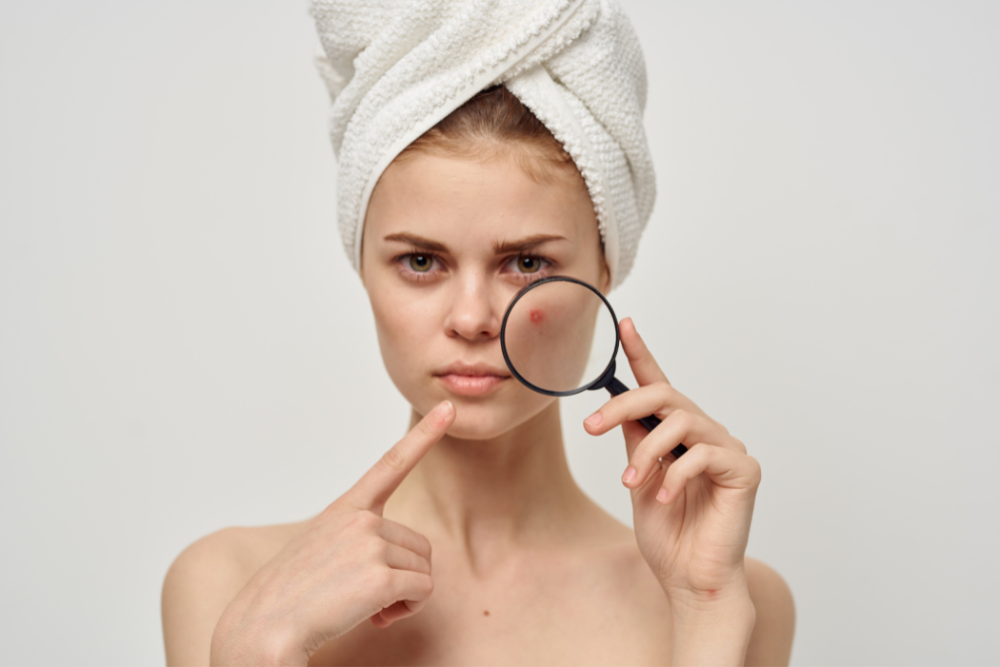 A split-screen image. One side shows a close-up of a face with acne breakouts. The other side shows a close-up of a healthy, clear complexion.