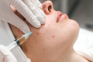 Read more about the article Acne 101: Demystifying Breakouts