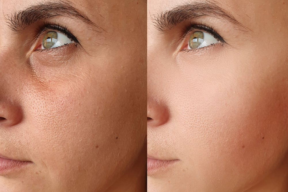 A split-screen image. On one side, a person's face showcases visible wrinkles and signs of facial volume loss. The other side showcases a person with a smoother, plumper, and more youthful appearance, subtly highlighting the effects of collagen injections.