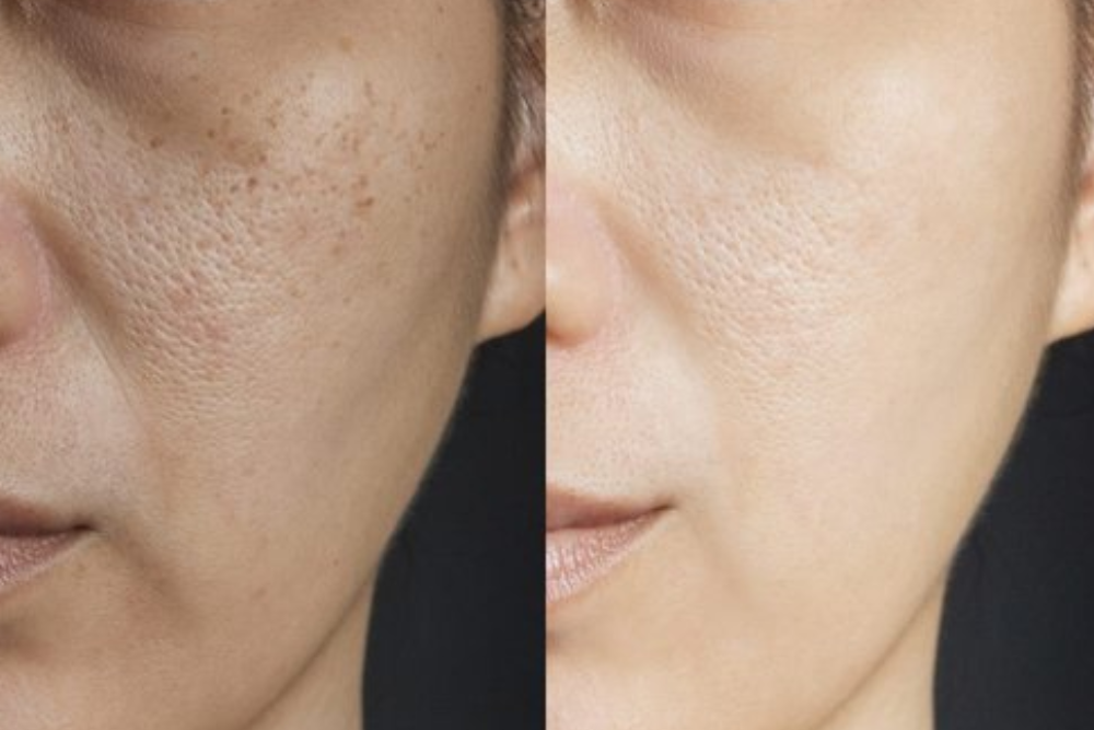 A split-screen image. On one side, a person is consulting a dermatologist with a concerned expression. On the other side, a close-up photo of healthy, glowing skin.