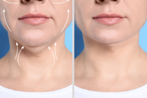 Read more about the article Kybella Myths Debunked: Fact vs. Fiction