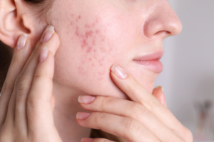 Read more about the article Adult Acne: Why It Happens and What You Can Do