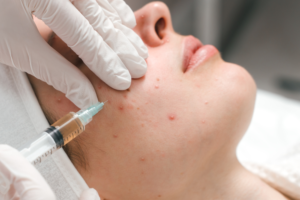 Read more about the article Medical-Grade Peels for Acne Scars: Can They Really Help?