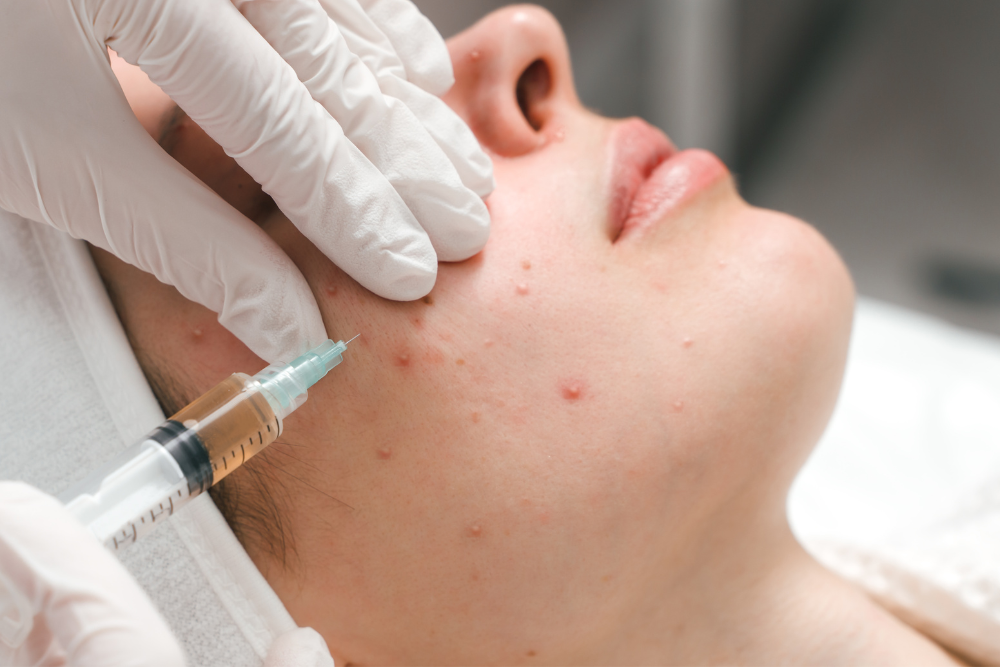 You are currently viewing Medical-Grade Peels for Acne Scars: Can They Really Help?