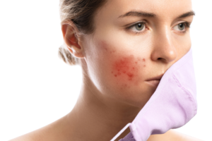 Read more about the article Adult Acne: Understanding and Treating Late-Onset Breakouts