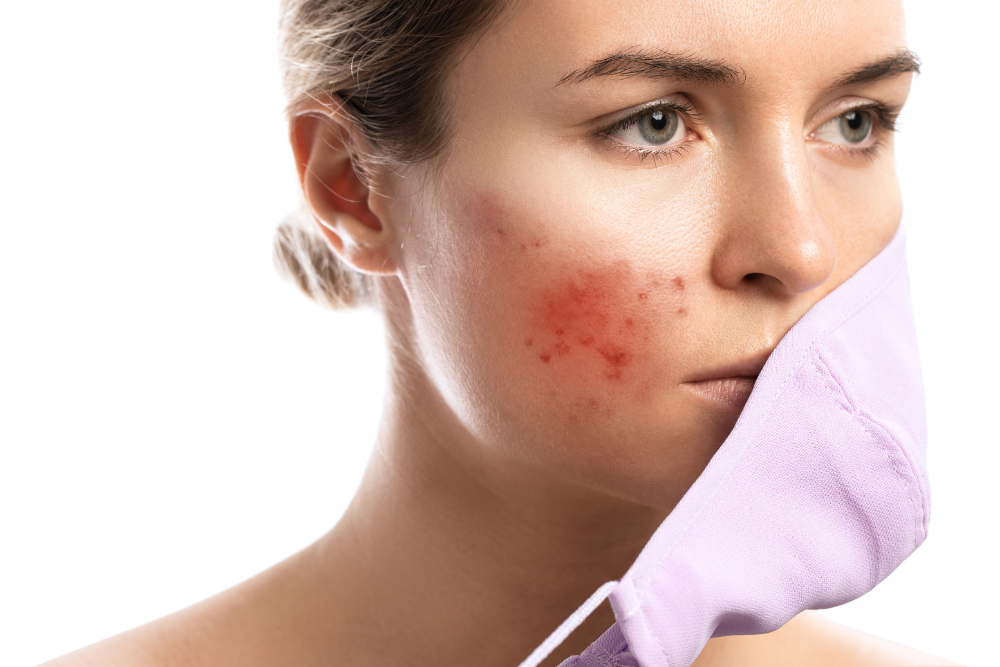 You are currently viewing Adult Acne: Understanding and Treating Late-Onset Breakouts