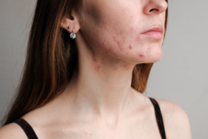 Read more about the article Cystic Acne: A Deeper Look