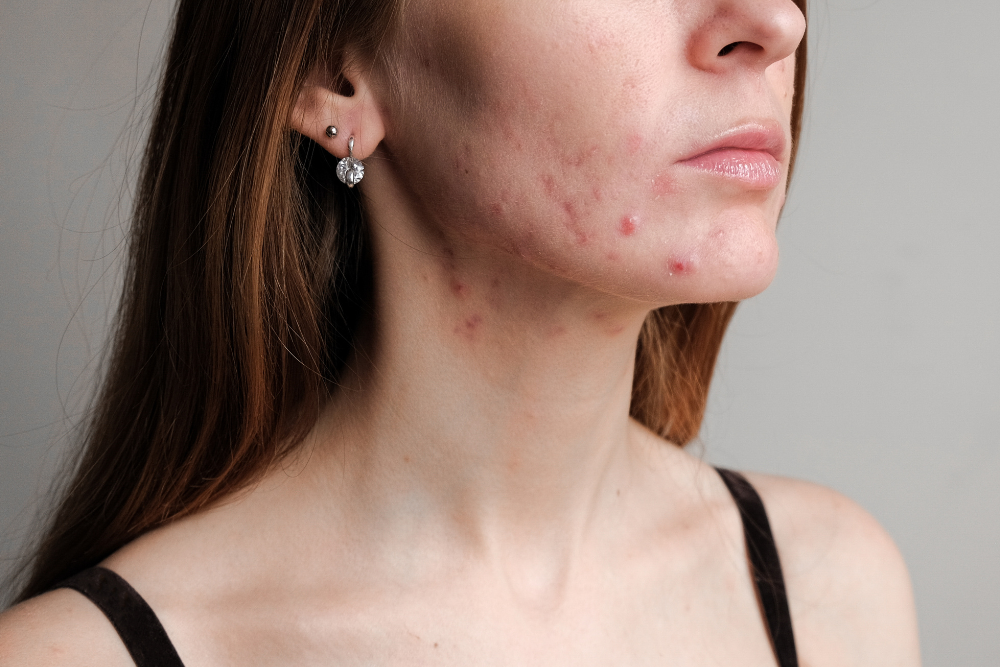 You are currently viewing Cystic Acne: A Deeper Look