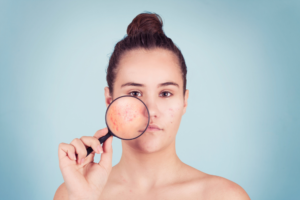 Read more about the article The Science Behind Acne: A Comprehensive Guide