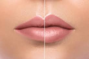 Read more about the article Restylane Kysse vs. Other Lip Fillers: Which is Right for You?