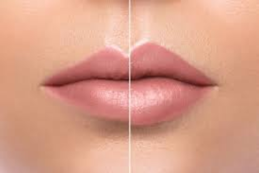 You are currently viewing Restylane Kysse vs. Other Lip Fillers: Which is Right for You?