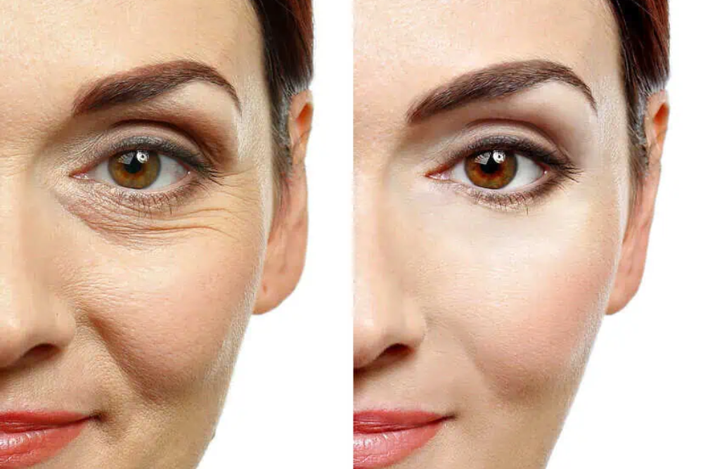 You are currently viewing Natural Rejuvenation: The Long-Term Benefits of Under-Eye PRP