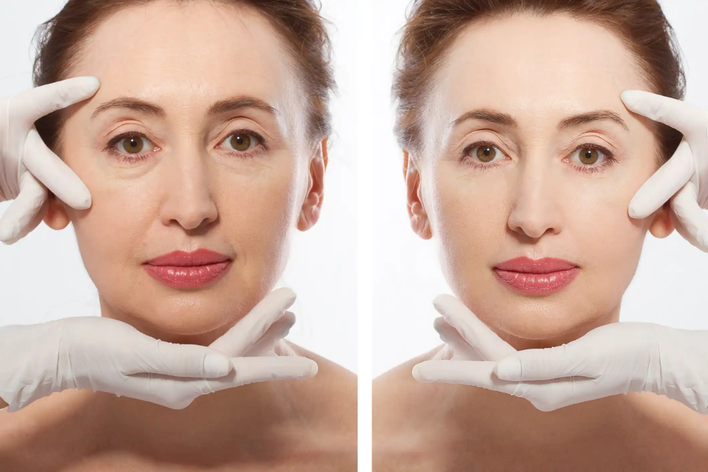 You are currently viewing PRP Facelifts vs. Traditional Facelifts: Pros and Cons