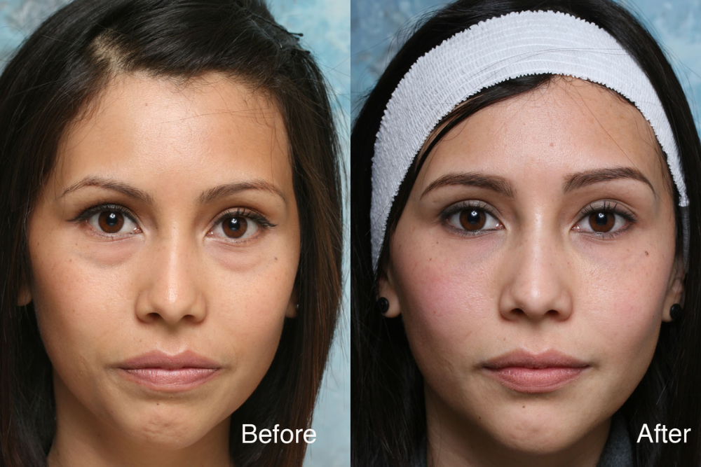 You are currently viewing Juvéderm vs. Other Fillers: Which is Best for Midface Correction?