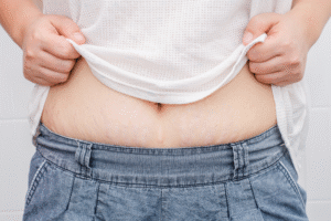 Read more about the article Microneedling for Stretch Marks: Fading Them Away Naturally