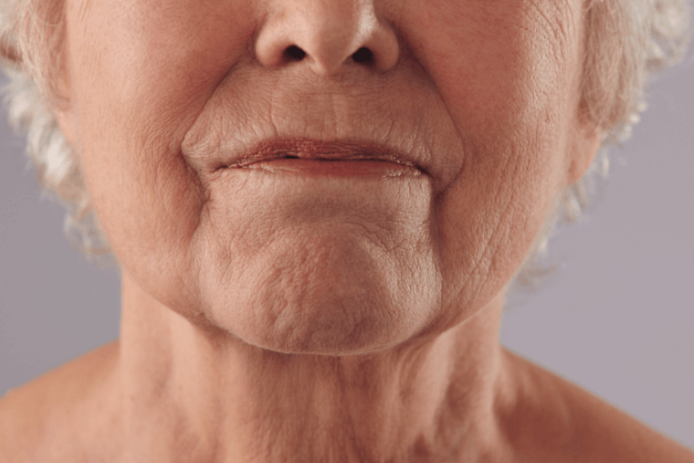 You are currently viewing Beyond Age: Surprising Factors That Can Contribute to Chin Wrinkles
