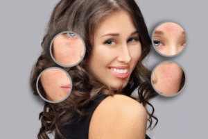 Read more about the article Medical-Grade Peels for Acne Scars: Can They Really Help?