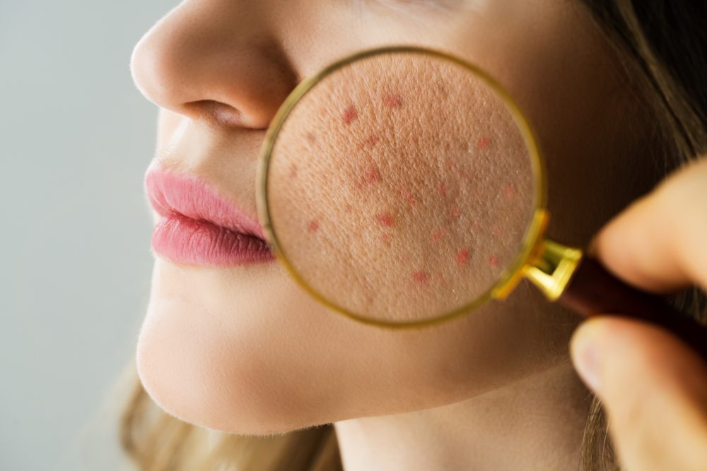 You are currently viewing Hot Weather, Cool Skin: Managing Oily, Acne-Prone Summer Skin