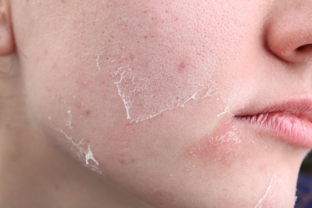 You are currently viewing Dehydrated or Dry Skin? How to Hydrate Properly This Summer
