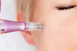Read more about the article Microneedling vs. Other Skin Rejuvenation: Your Guide