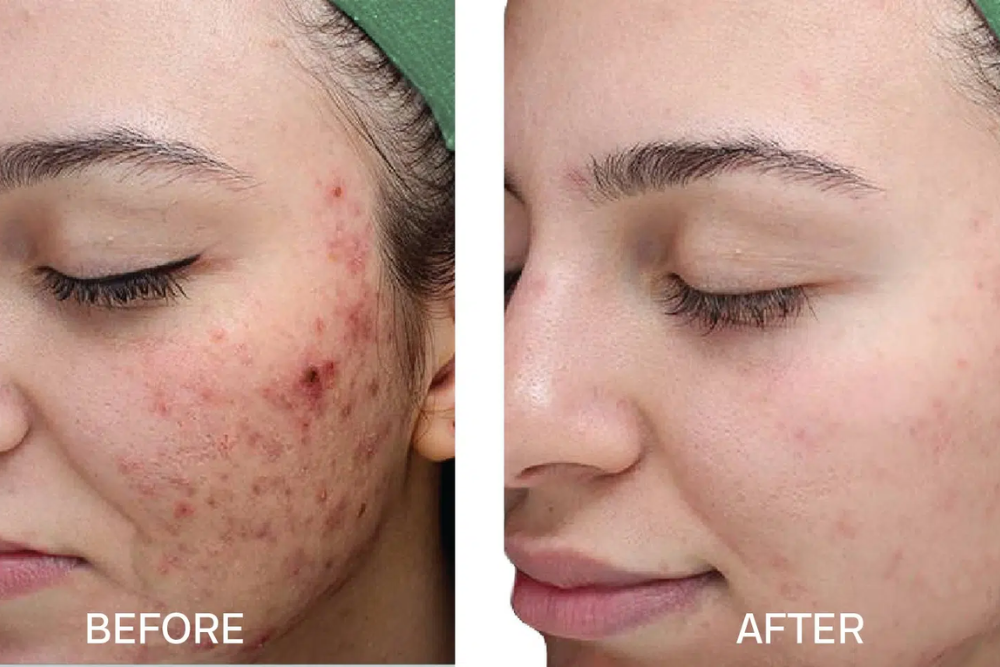 You are currently viewing Medical-Grade Peels: A Guide for Your Skin Type