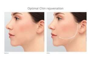 Read more about the article The Power of Combination: Optimal Chin Rejuvenation