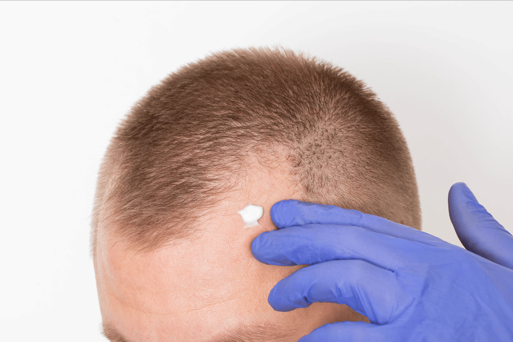 You are currently viewing Hair Restoration: Your Guide to a Fuller Head