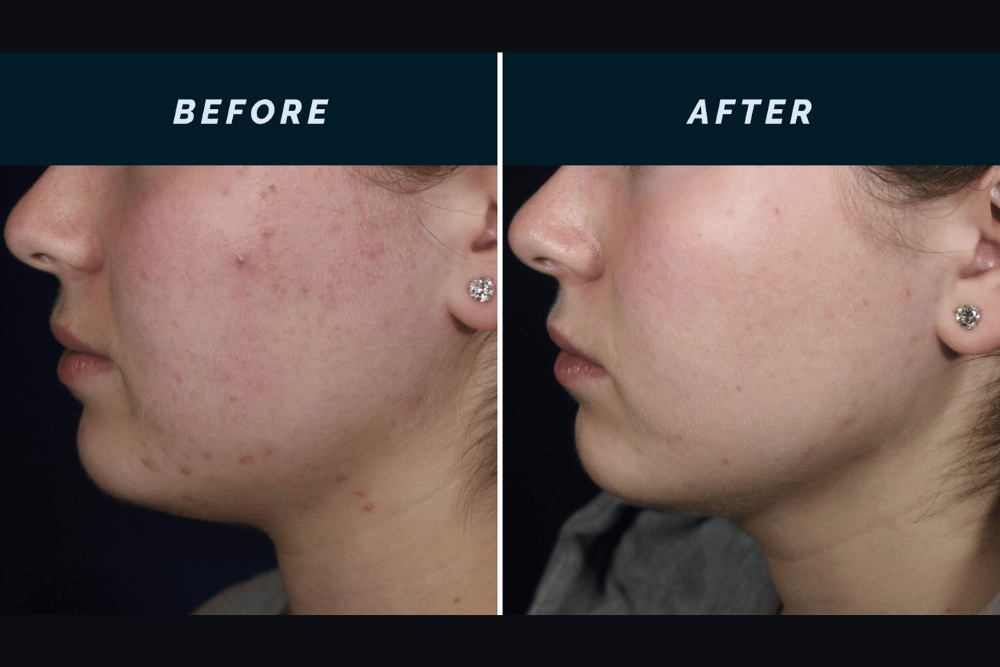 You are currently viewing Chin Rejuvenation: Microneedling & RF