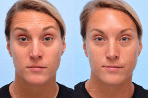 Read more about the article Wrinkle-Proofing Your Winter: How Injectables Prevent the Frown Lines Caused by Squinting in Low Sunlight