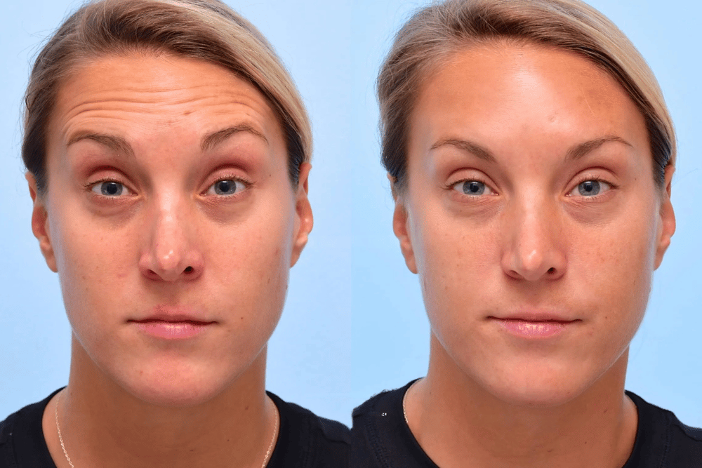 You are currently viewing Wrinkle-Proofing Your Winter: How Injectables Prevent the Frown Lines Caused by Squinting in Low Sunlight