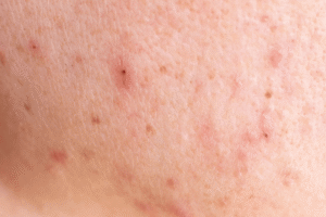 Read more about the article The “Barrier-First” Acne Strategy: Why We Stopped Stripping the Skin