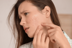 Read more about the article Exosomes for Acne: Healing Your Skin with Cellular Intelligence