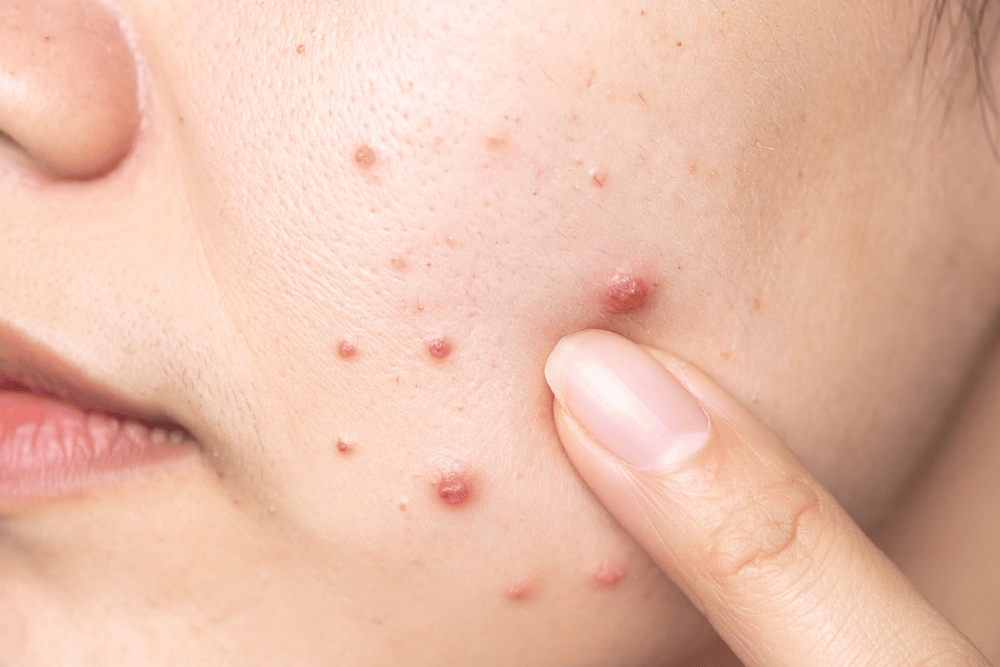 You are currently viewing Acne Isn’t a “Phase”—It’s a Disease That Deserves a Diagnosis