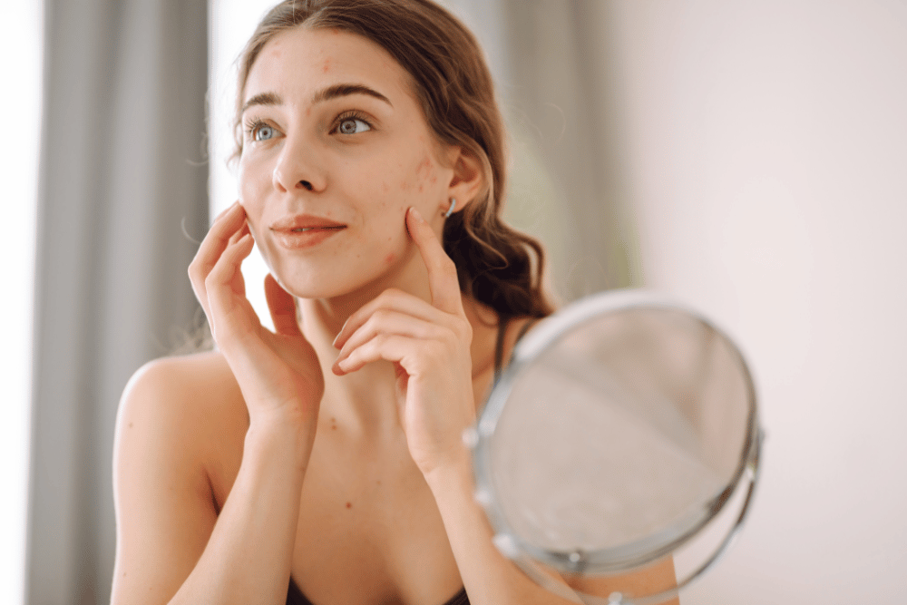 You are currently viewing The Preventable Tragedy of Acne: Scarring and Hyperpigmentation