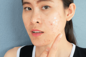 Read more about the article The Gut-Skin Connection: Why Your Acne Starts in Your Core