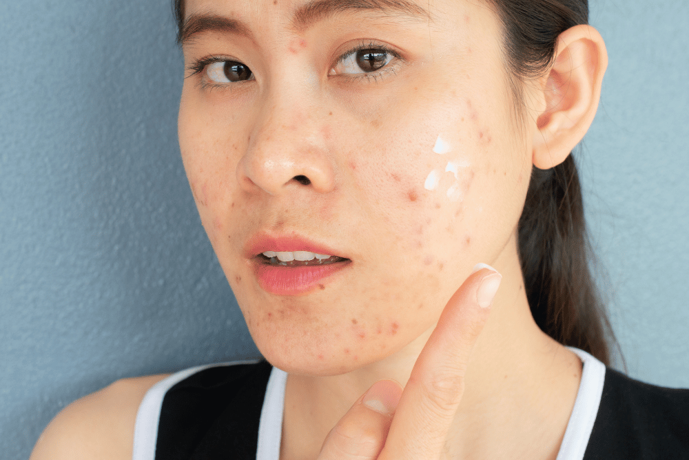 You are currently viewing The Gut-Skin Connection: Why Your Acne Starts in Your Core