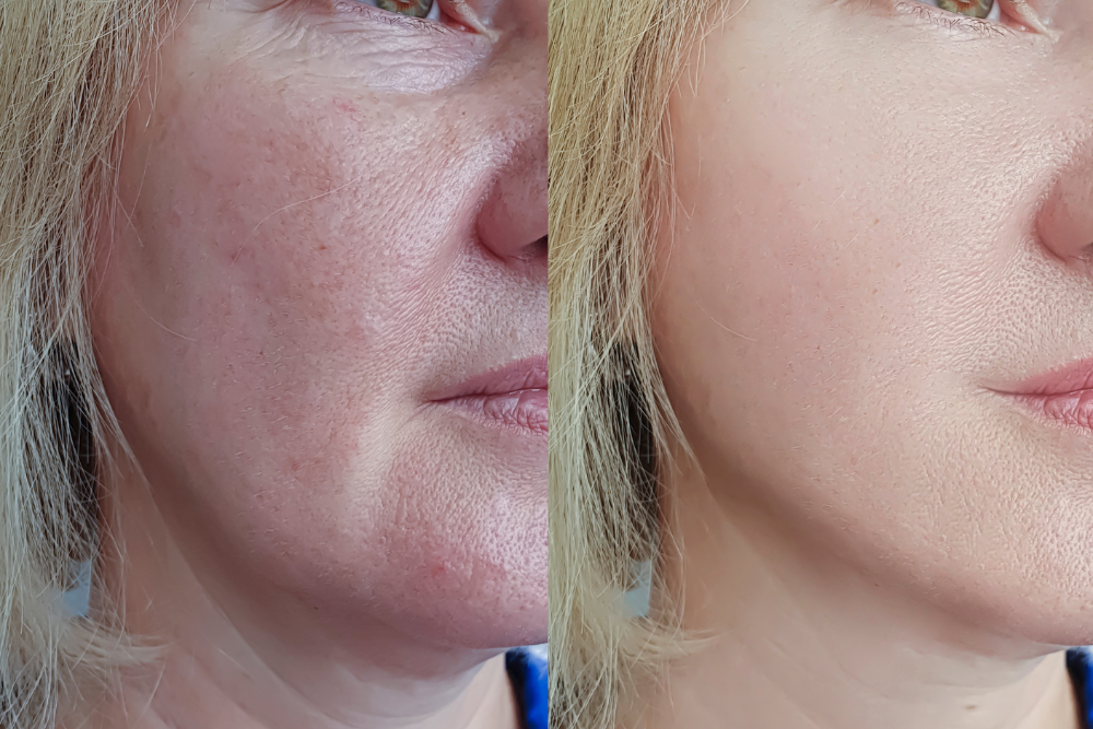 Before and after PRP under eye treatment showing brighter eyes in Scottsdale Arizona