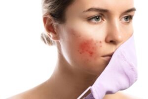 Read more about the article The Sebum Shift: Why Adult Acne is Radically Different from Teenage Breakouts