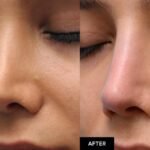 Life with a Liquid Nose Lift: How to Protect Your New Profile in the First 14 Days
