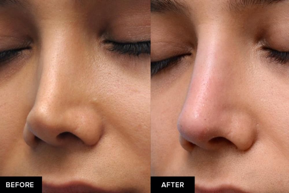 You are currently viewing Life with a Liquid Nose Lift: How to Protect Your New Profile in the First 14 Days