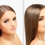 Red, Brown, or Pitted? How to Correct Every Type of Post-Acne Mark
