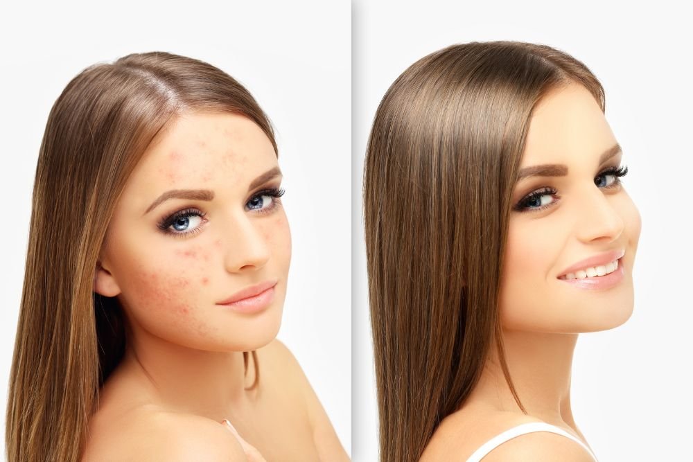 You are currently viewing Red, Brown, or Pitted? How to Correct Every Type of Post-Acne Mark
