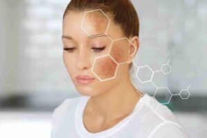 Read more about the article The Silent Pigment Wave: The Biology of Post-Inflammatory Hyperpigmentation (PIH)